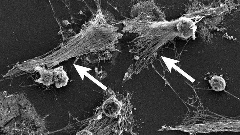 Investigan si las células inmunes hiperactivas causan la muerte por COVID-19