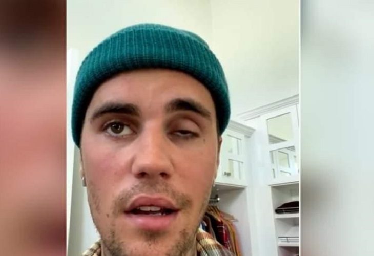 Qué es el síndrome de Ramsay Hunt, enfermedad que afectó la cara de Justin Bieber